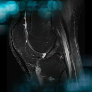 Management of a chronic multiligament knee injury