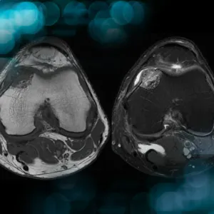 Management of an osteolytic lesion of the distal femur affecting the knee joint 