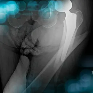 Management of a peri prostetic femoral fracture