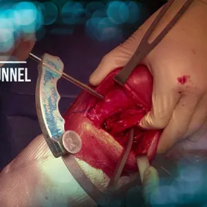 Combined anterior cruciate ligament reconstruction (ACLR) revision and double-bundle medial collateral ligament (MCL) and posterior oblique ligament (POL) reconstruction