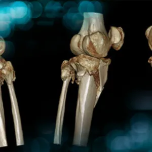 Management of a post fracture complicated leg deformity with a 30° tibial slope