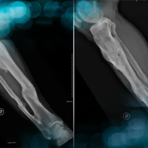 Management of Total Knee Arthroplasty in Post-Traumatic Malunion with Severe Deformity