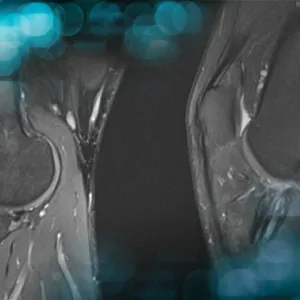Re-revision ACL reconstruction plus meniscal transpalantation in a young patient